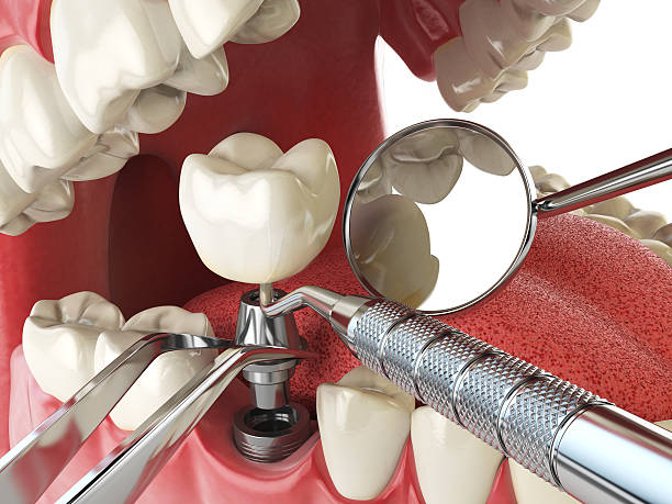 Best Emergency Dentist for Lost Fillings or Crowns in Mills, WY